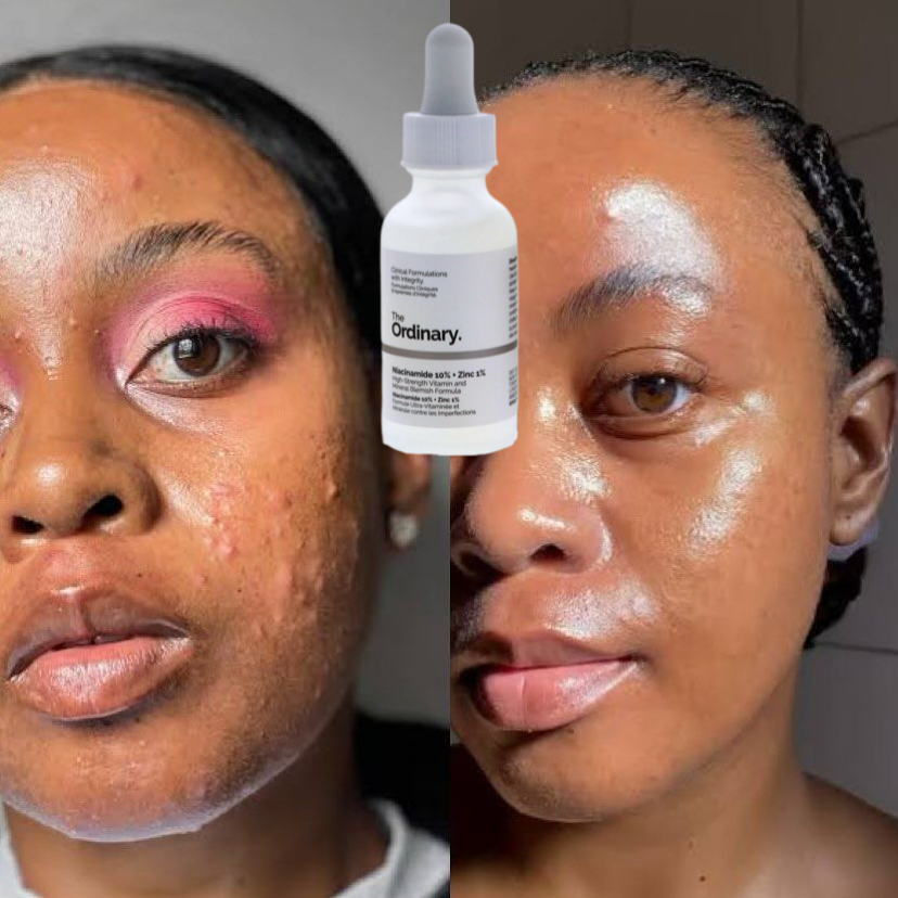 The Ordinary – Sérum Niacinamide 10% + Zinc 1% | Anti-Imperfections & Peau Nette